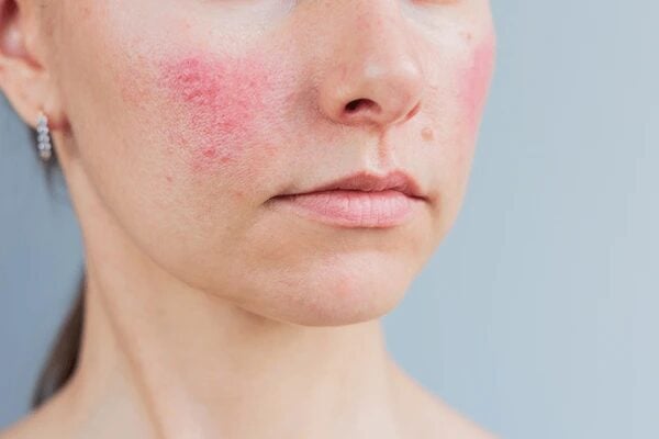 Close-up of the lower half of a woman's face, showing a prominent patch of redness and inflammation on her left check consistent with rosacea. Her lips are neutral, and the background is plain, drawing attention to the skin texture and discoloration.