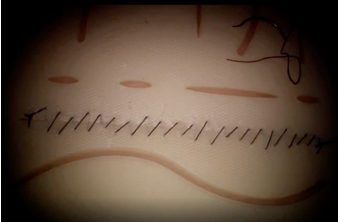 8cm wound closed with continuous baseball suture by teleoperating the da Vinci Research Kit