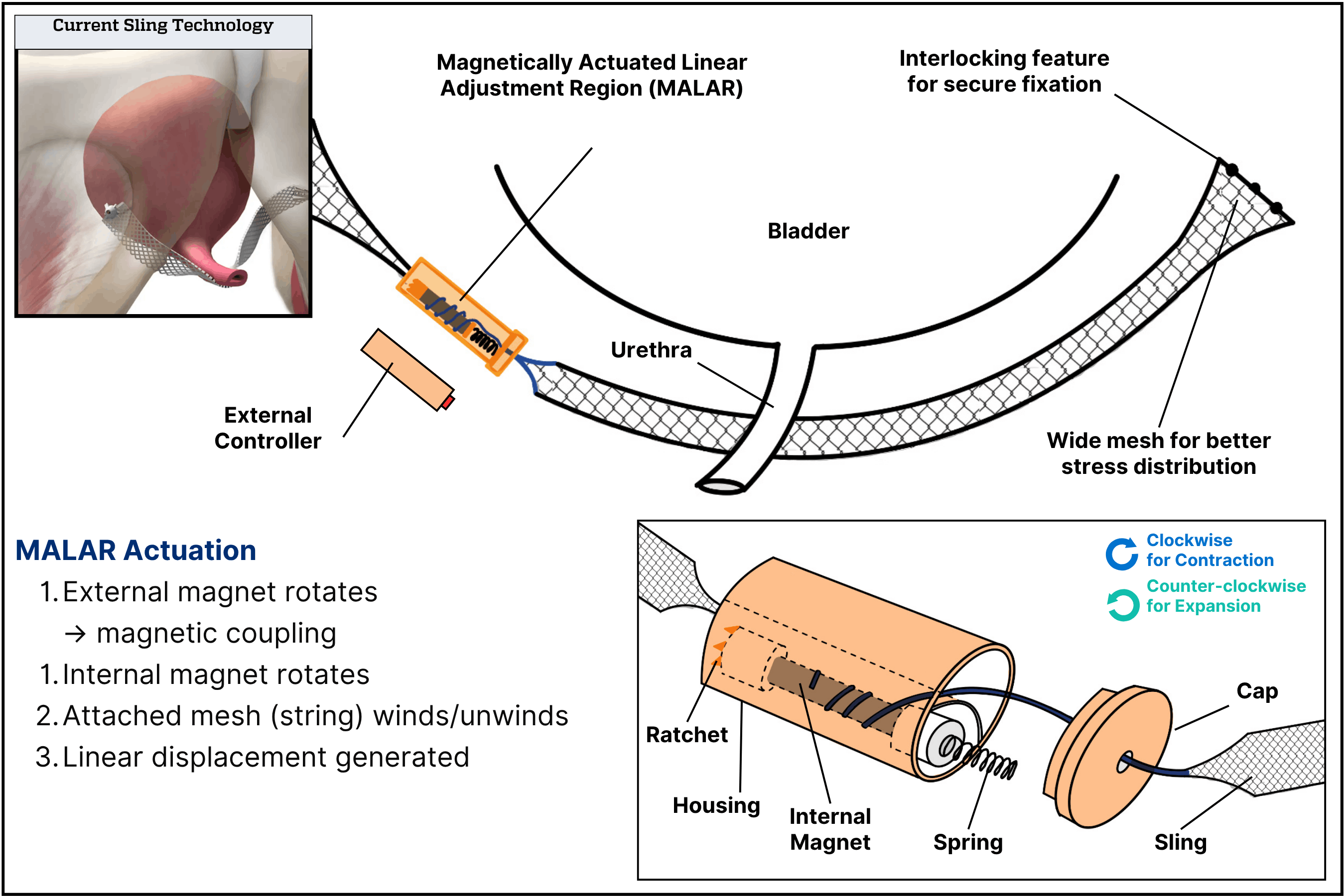 Schematic of a magnetically adjustable mid-urethral sling. The top left shows current sling technology. The center illustrates the proposed design and magnetic actuation method. The bottom right shows an internal view of the MALAR mechanism.