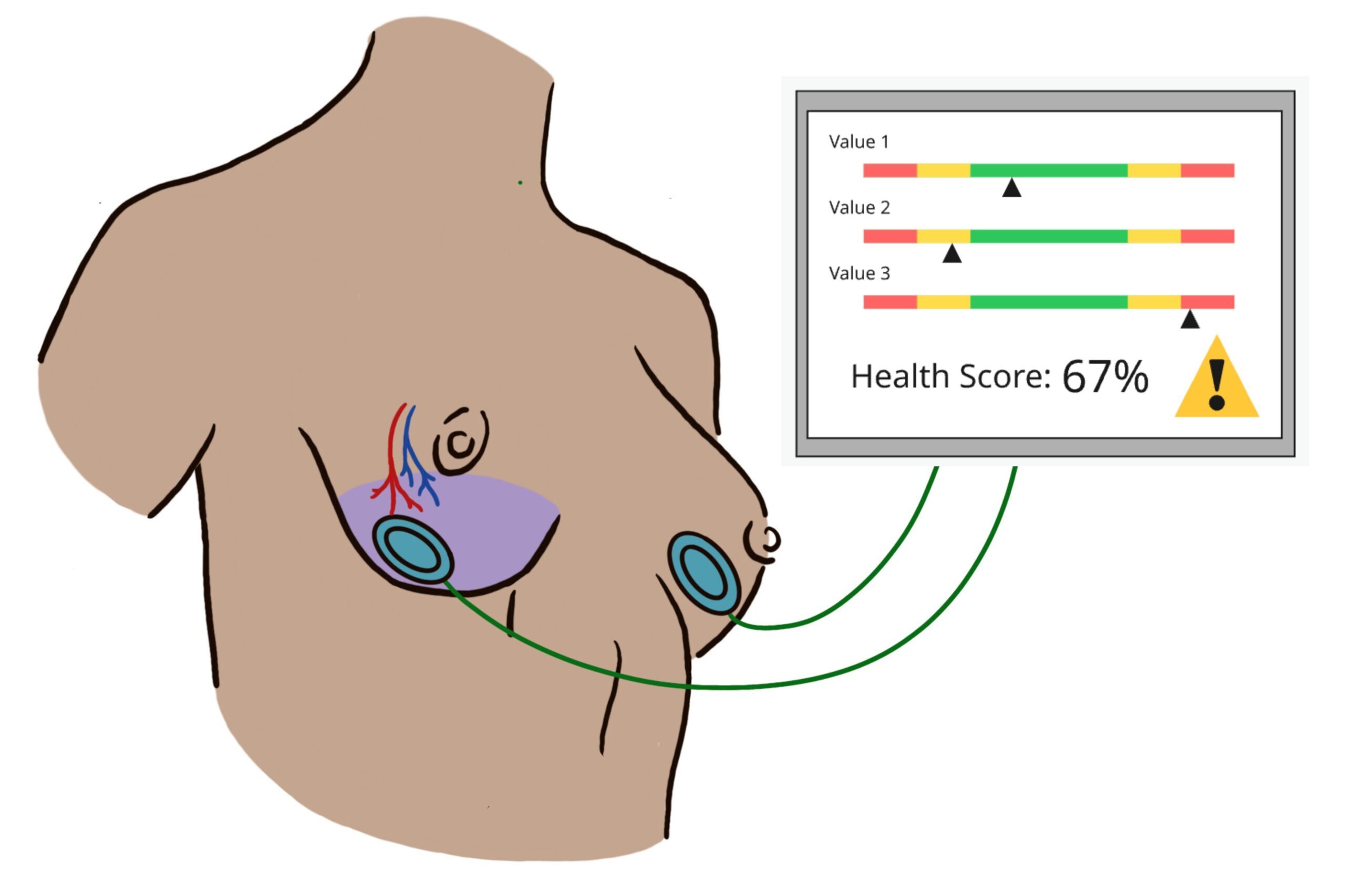 Illustration of a torso with sensors attached to both lower breasts connected to a monitor displaying three value bars and a 67% health score. Highlighted breast region shows underlying vessels, and purple color, indicating potential vascular compromise.