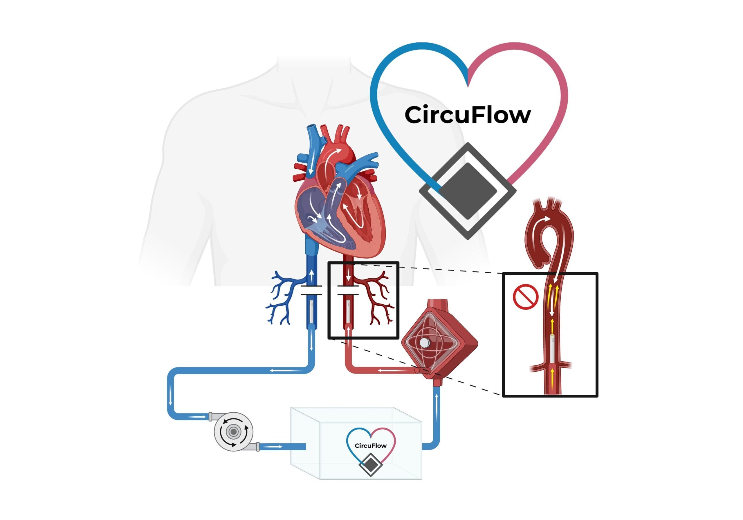 CircuFlow, a non-invasive device spliced into the VA-ECMO circuit, reduces afterload and alleviates LV burden.
