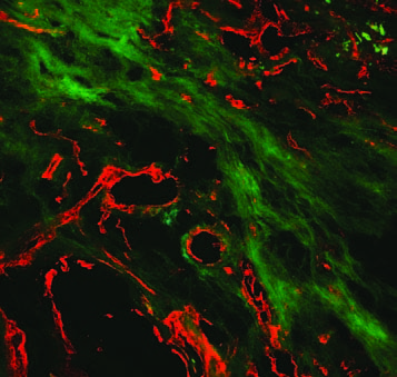 Mimetic peptides bind with collagen proteins to create modified collagen that could help prevent the formation of scar tissue.
