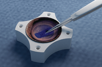 Corneal Transplant