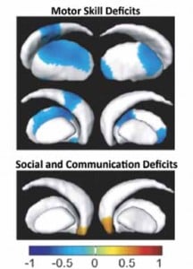 CIS autism MRI