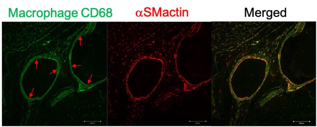 Three photos of immunofluorescence microscopy data: green, CD68 marker staining, Fibroblastic (red, alpha-smooth muscle actin) and co-localization at the surface of implanted biomaterial spheres to yield biomaterial fibrosis.