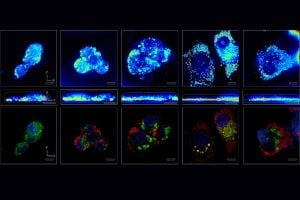 A series of Quantitative Phase Imaging and Fluorescence imaging photos of cells demonstrating the accumulation of lipid vesicles.