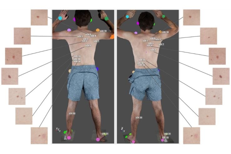 Using Computer Vision to Catch Early-Stage Skin Cancer - Johns Hopkins ...