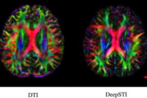 Side-by-side brain imaging maps using two MRI techniques. On the left, a colorful DTI scan of a human brain with 3T resolution, and on the right, a DeepSTI-enhanced STI scan at 7T resolution. Both are detailed to show brain fiber orientations.