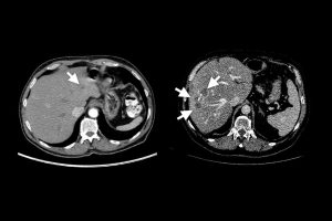 Left: A CT scan of a liver, with arrows pointing at a tumor. Right: A synthetic scan of a liver with arrows pointing at a tumor.