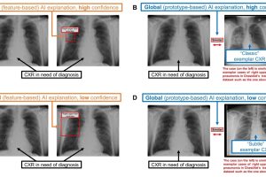 Chest radiograph examples of local vs. global AI explanations.