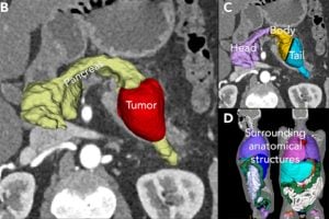 Multiple CT views of the pancreas showing a highlighted pancreatic tumor and color-coded segmentations of the pancreas (head, body, tail) and nearby anatomical structures.