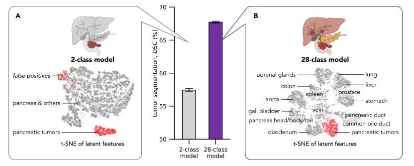 Performance plots comparing AI models trained on different pancreatic CT datasets, showing higher tumor detection and segmentation accuracy for models trained on the PanTS dataset.