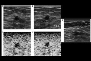 Breast ultrasound: B‑mode vs SLSC views of a small mass; SLSC shows darker fluid‑like content, with pre/post aspiration confirming a benign cyst.