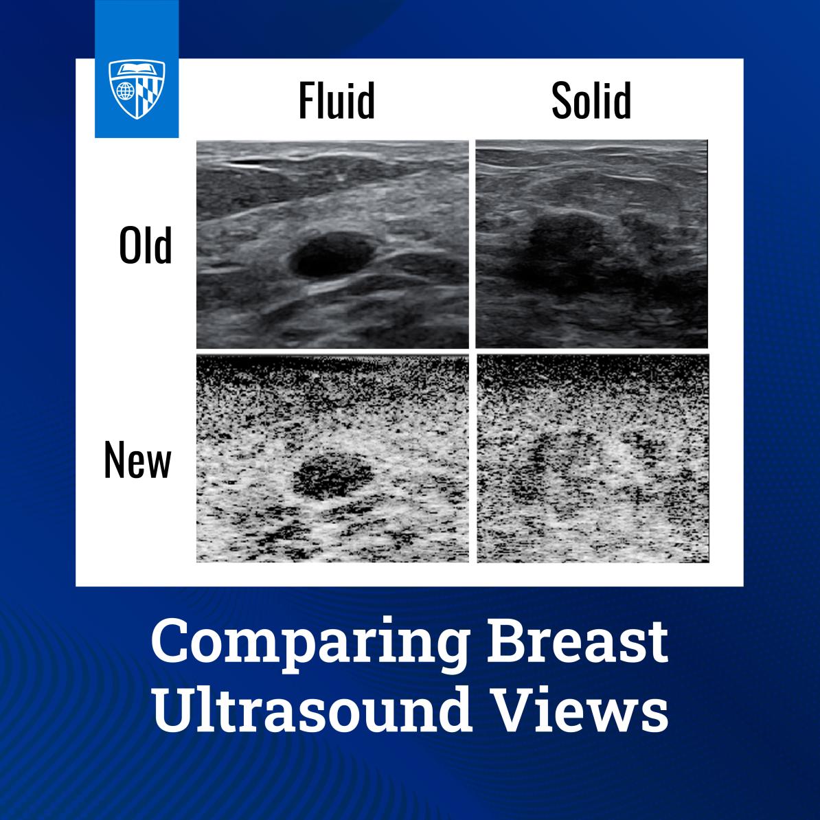 Comparing breast ultrasound views: two columns labeled Fluid and Solid; top row Old, bottom row New. The new view makes the fluid cyst darker and distinct, while the solid mass remains textured.