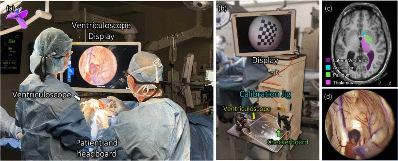 “Four-panel figure showing: surgeons performing neuroendoscopy with a ventriculoscope and monitor; a calibration setup with a checkerboard pattern; a brain MRI with colored segmented deep-brain structures; and an endoscopic image of the ventricle with visible tissue and blood vessels.” 